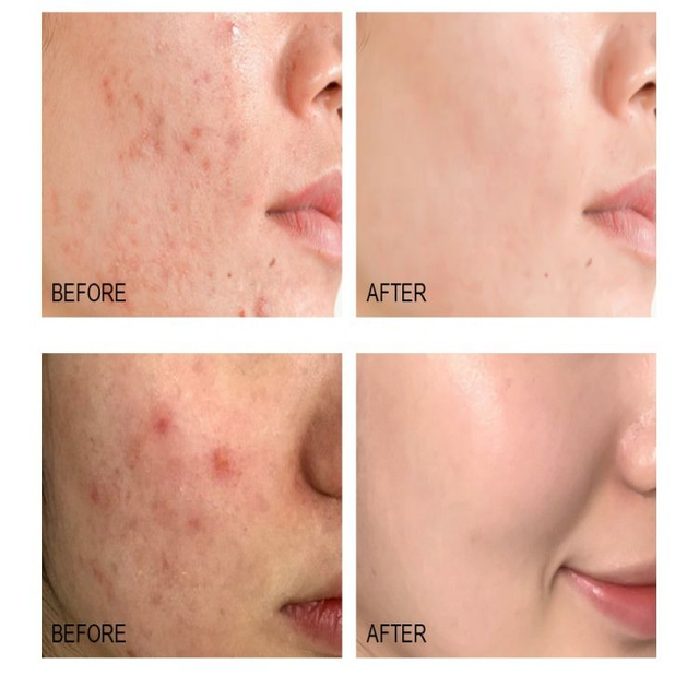 sérum contre l'acné